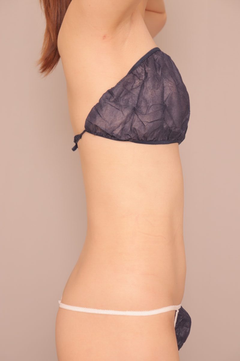 ベイザー脂肪吸引（３ヶ月経過：43）の術後写真