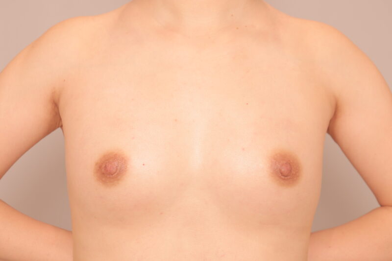 ベイザー脂肪吸引(3ヶ月経過:43)の術後写真