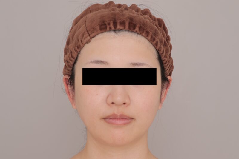 ベイザー脂肪吸引(3ヶ月経過:29)の術前写真