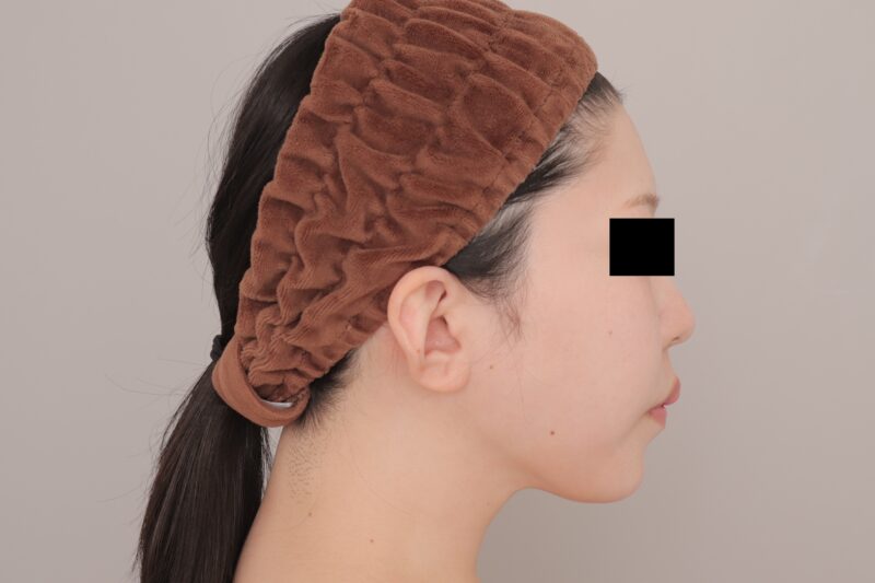 ベイザー脂肪吸引（3ヶ月経過：27）の術後写真