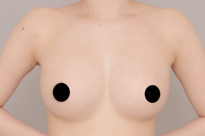 ベイザー脂肪吸引（３か月後経過：21）の術後写真