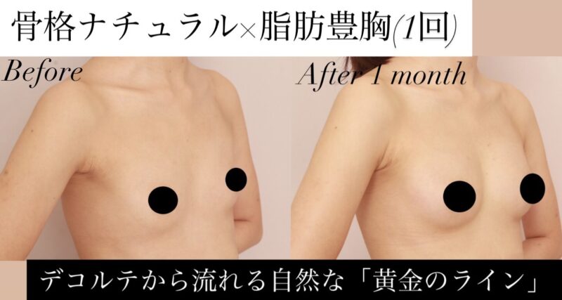 【骨格ナチュラル×脂肪豊胸】デコルテから流れる自然な「黄金のライン」が誕生