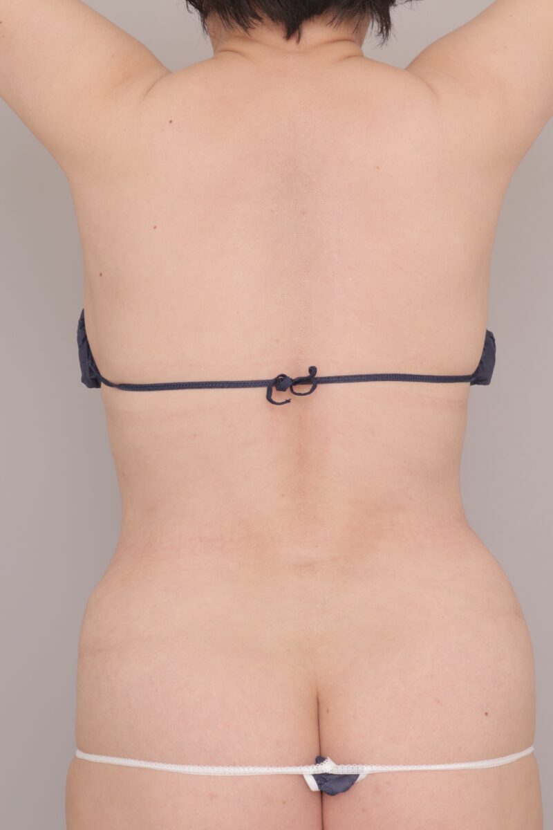 ベイザー脂肪吸引（6ヶ月経過：45）の術後写真