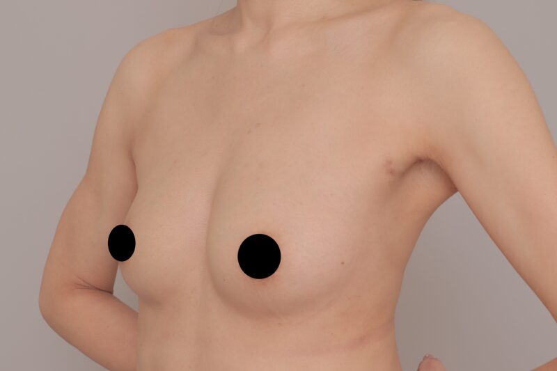 ベイザー脂肪吸引（３か月後経過：47）の術後写真