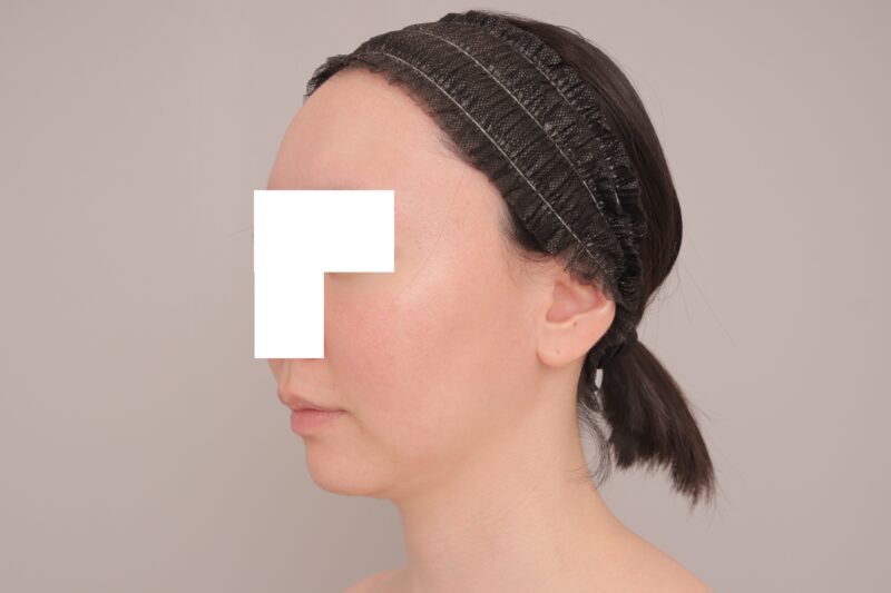 ベイザー脂肪吸引(3ヶ月経過:28)の術前写真