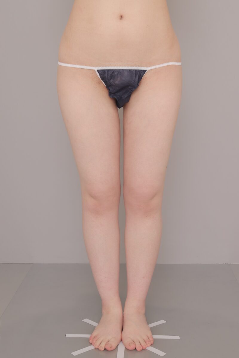 ベイザー脂肪吸引（6ヶ月経過：24）の術後写真