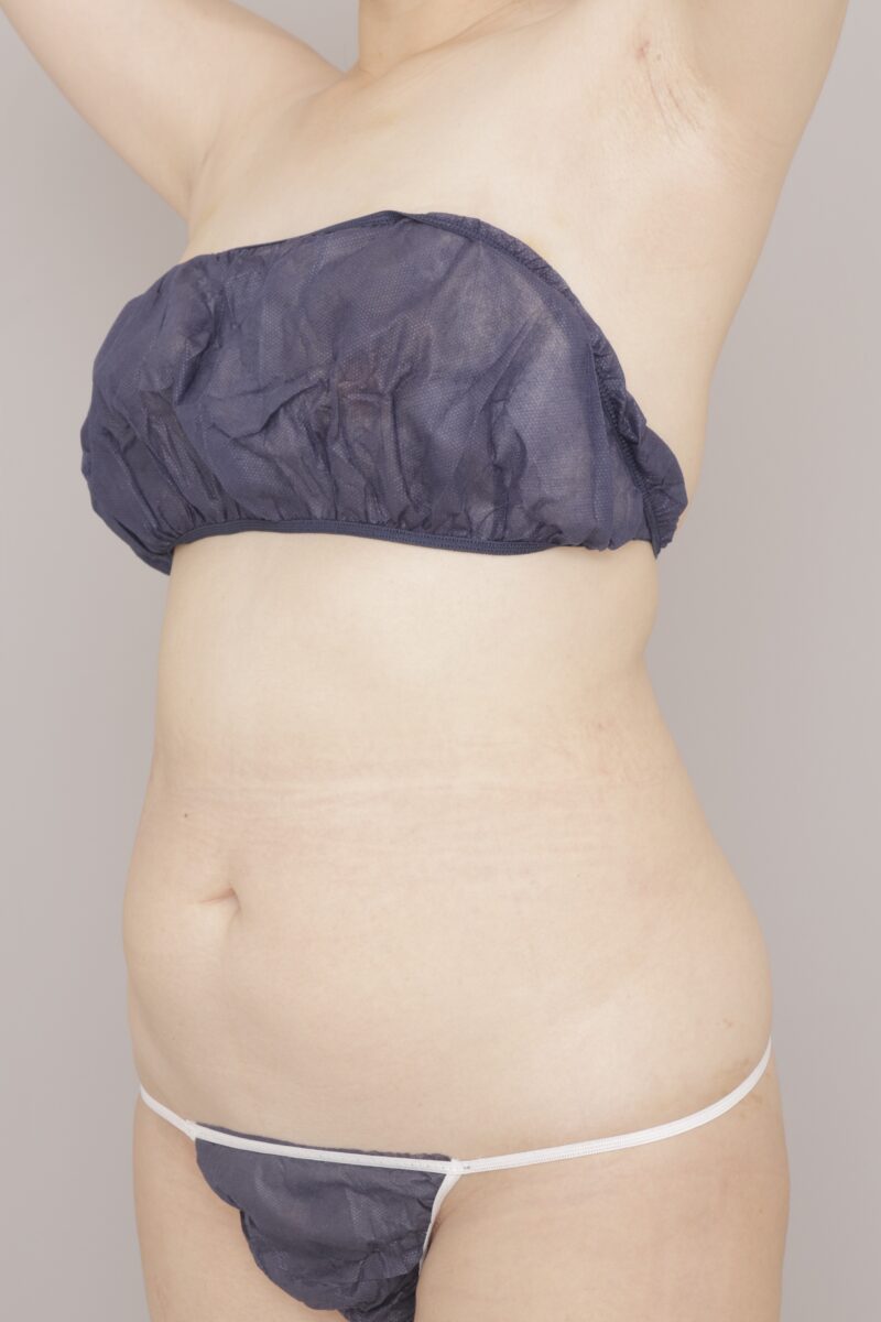 ベイザー脂肪吸引（3ヶ月経過：40）の術前写真