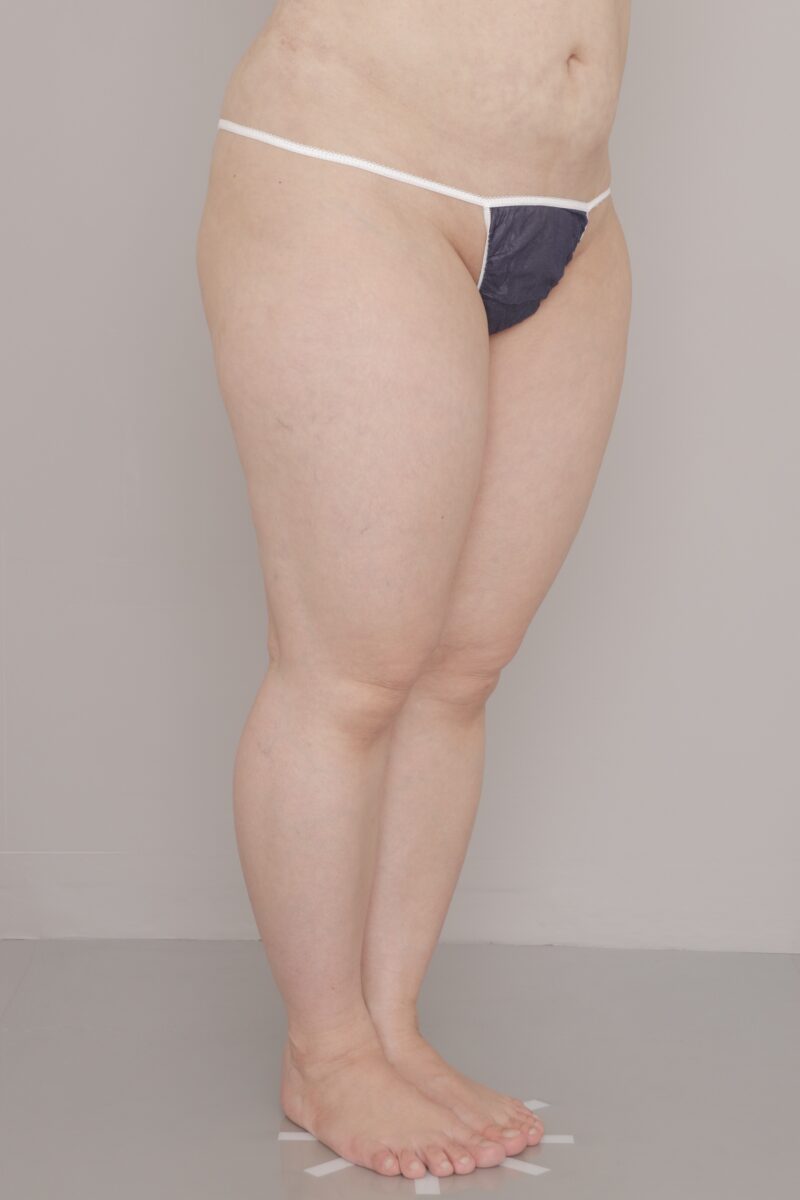 ベイザー脂肪吸引（4ヶ月経過：45）の術前写真