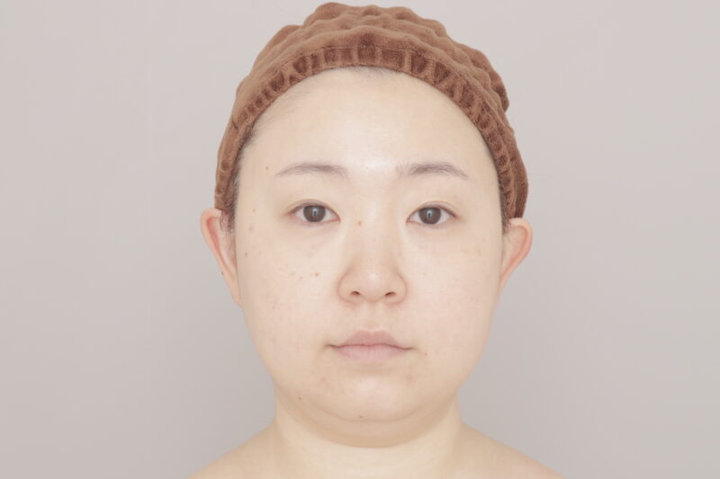 ベイザー脂肪吸引(3ヶ月経過:35)の術前写真