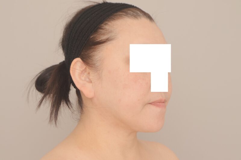 ベイザー脂肪吸引（3ヶ月経過：52）の術後写真