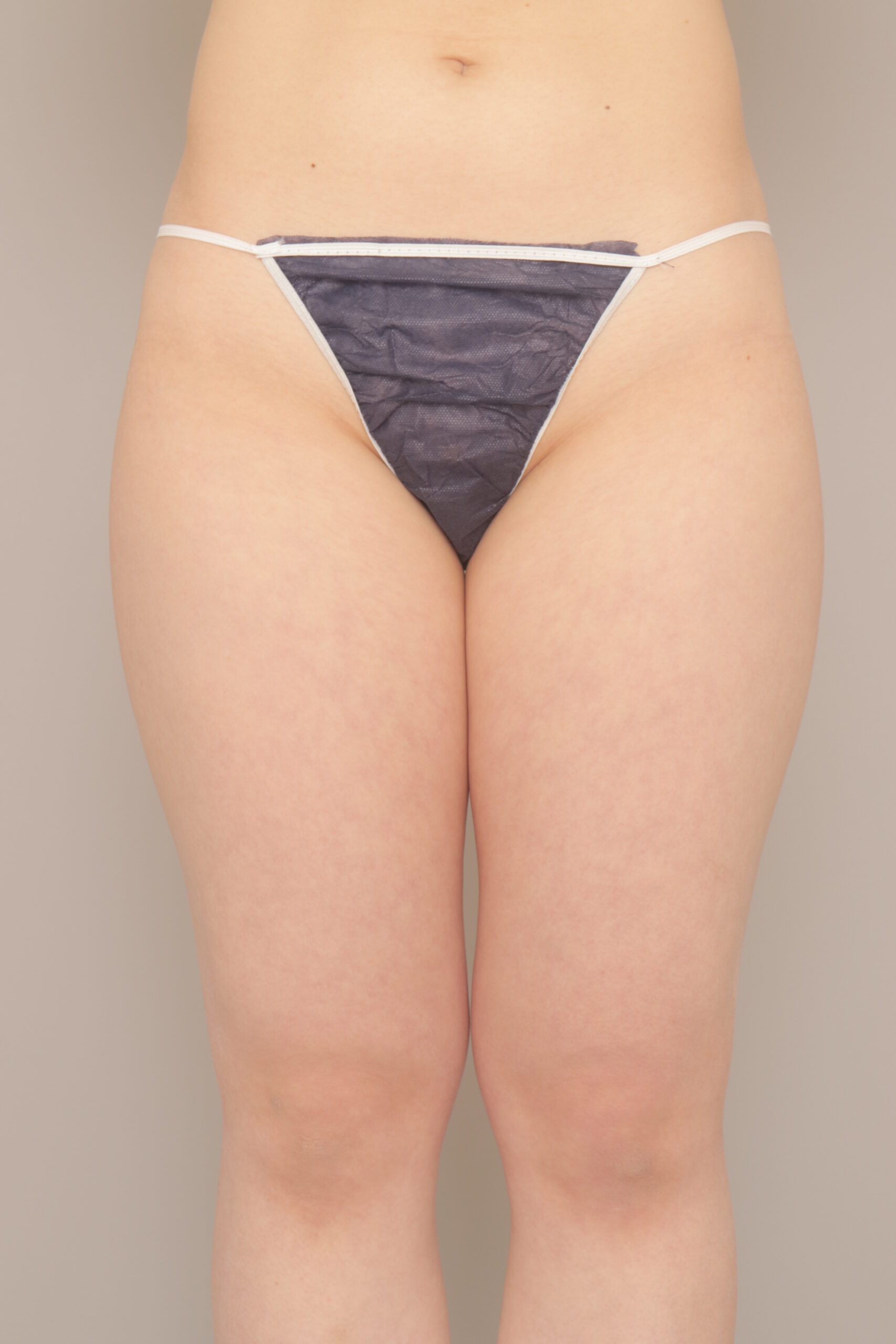 ベイザー脂肪吸引（1ヵ月経過：22）の術前写真