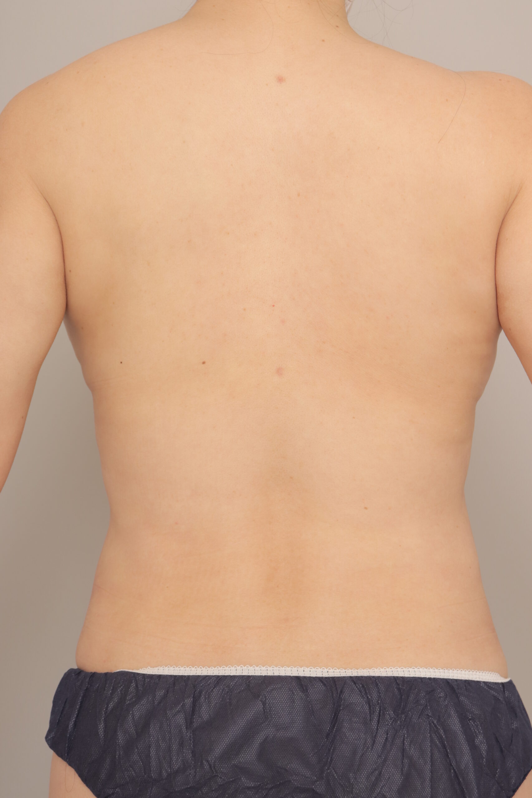 ベイザー脂肪吸引（6か月経過：39）の術後写真