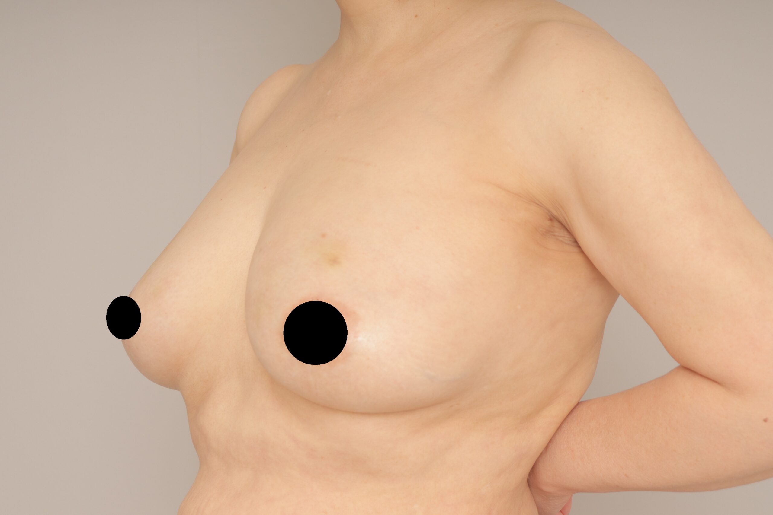 ベイザー脂肪吸引（1ヵ月経過：58）の術後写真