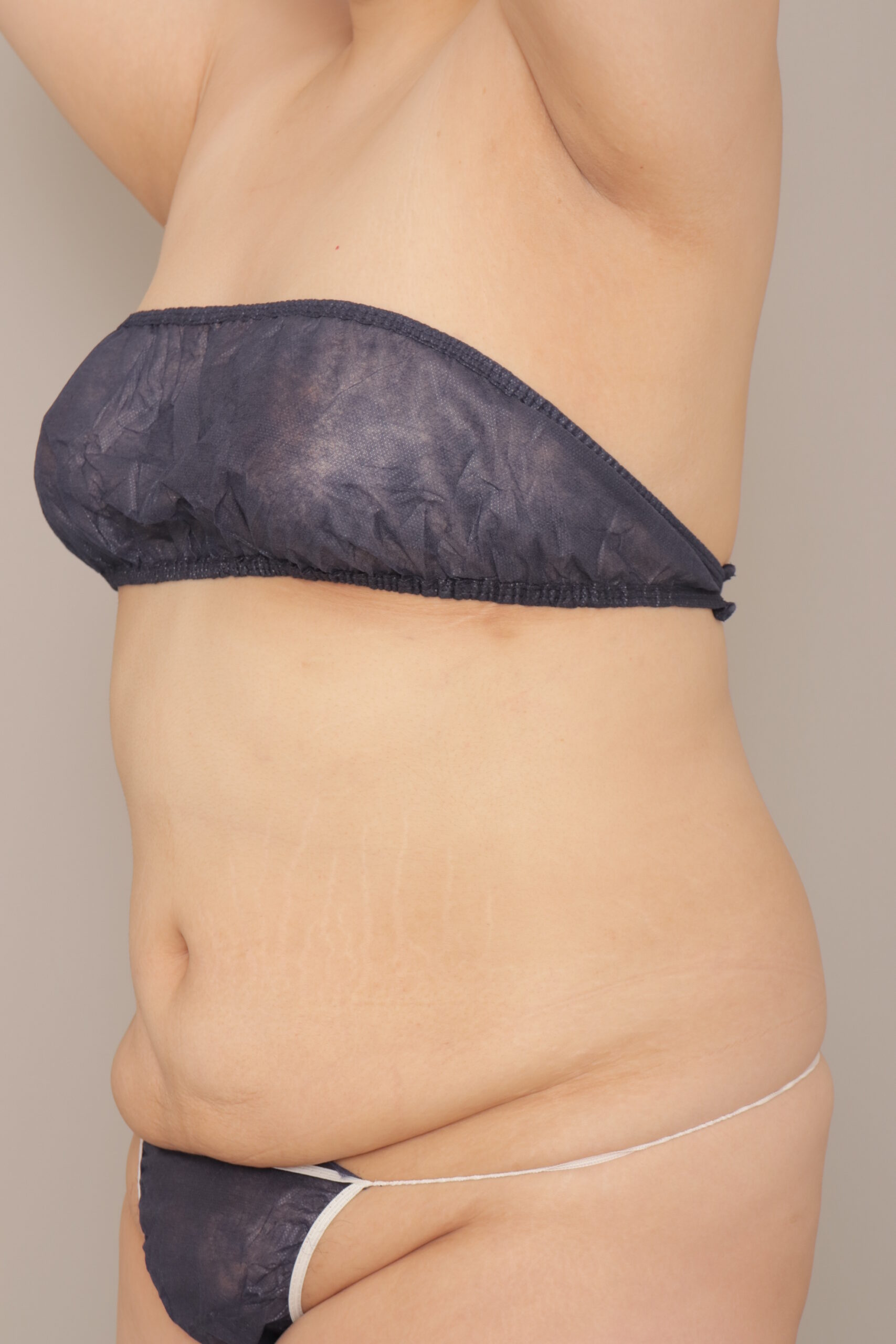 ベイザー脂肪吸引（４か月経過：22）の術後写真