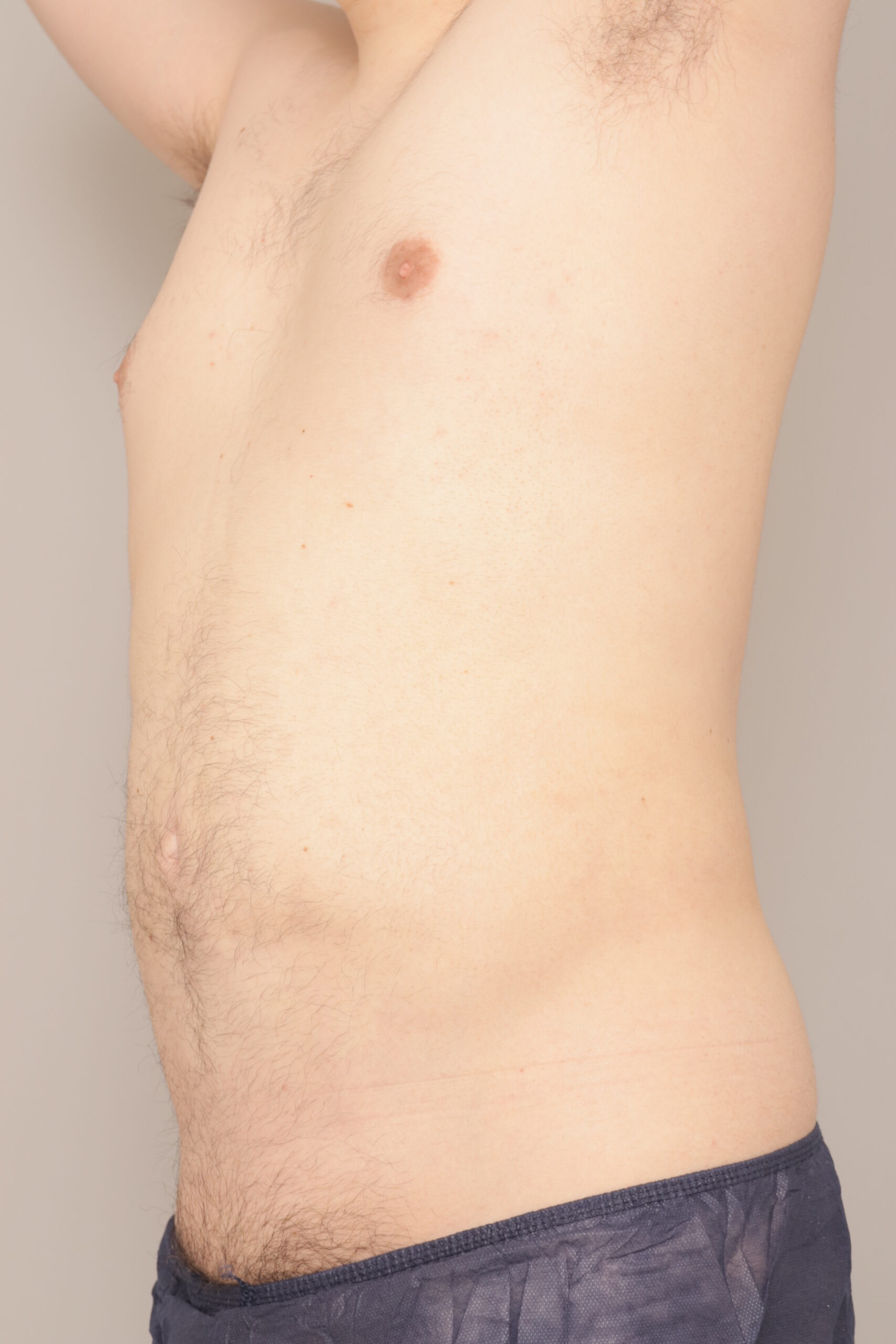 ベイザー脂肪吸引(3か月経過:45)の術後写真