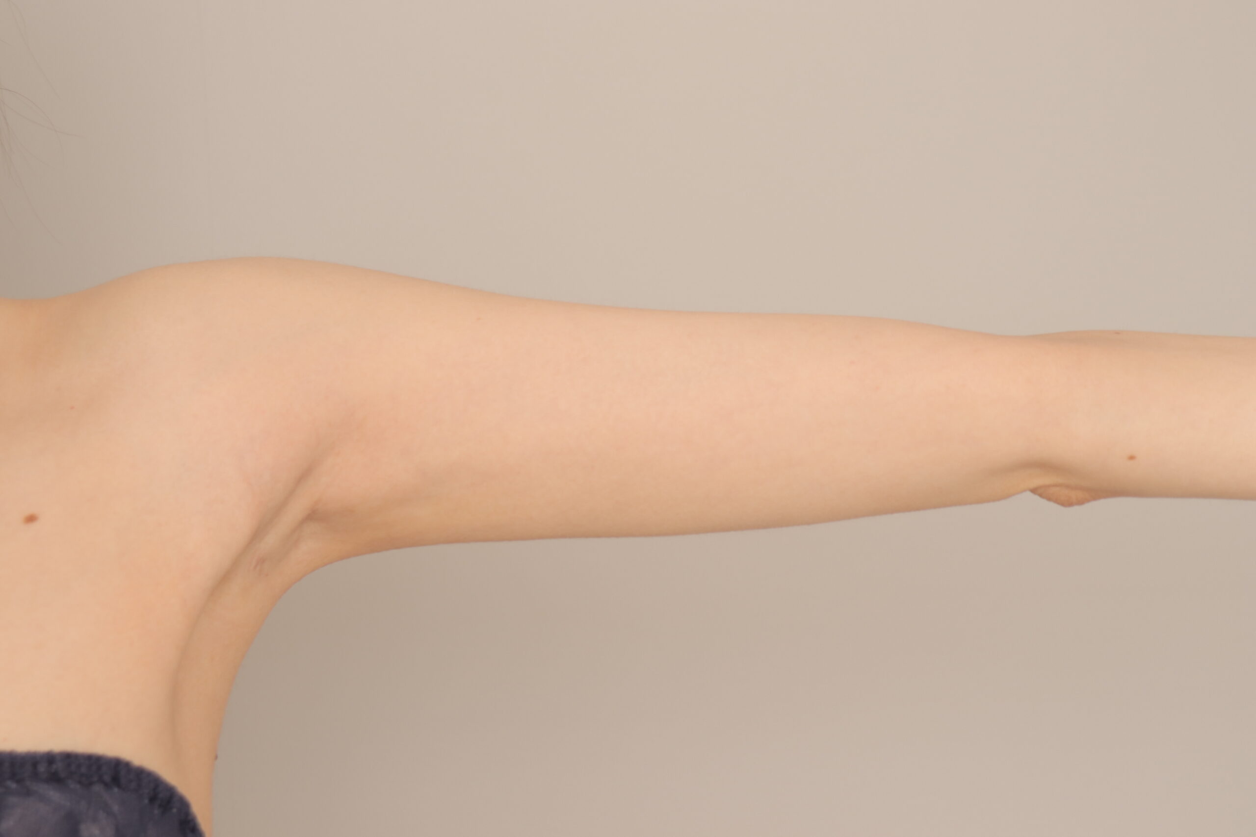 ベイザー脂肪吸引(6か月経過:31)の術後写真