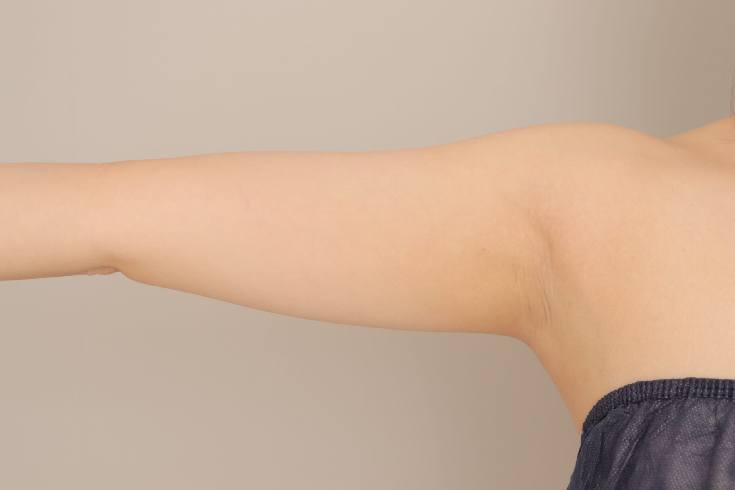 ベイザー脂肪吸引（１ヶ月経過：27）の術前写真