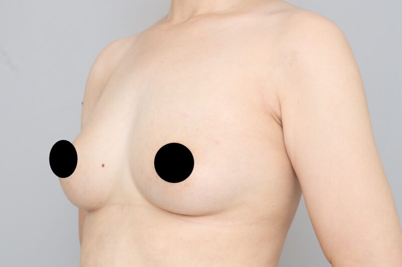 ベイザー脂肪吸引（４ヶ月経過：40）の術後写真