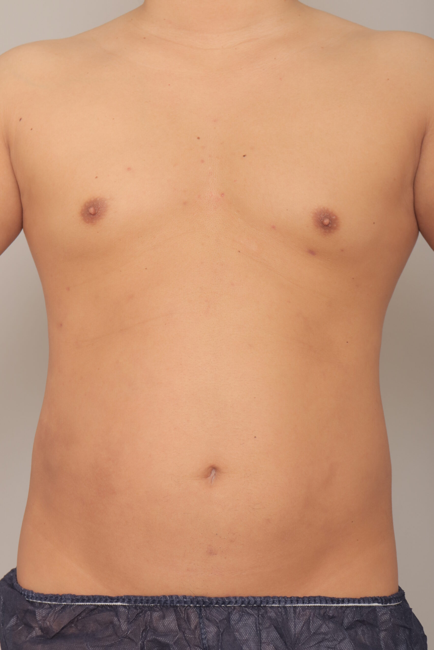 ベイザー脂肪吸引（６か月経過：30）の術後写真