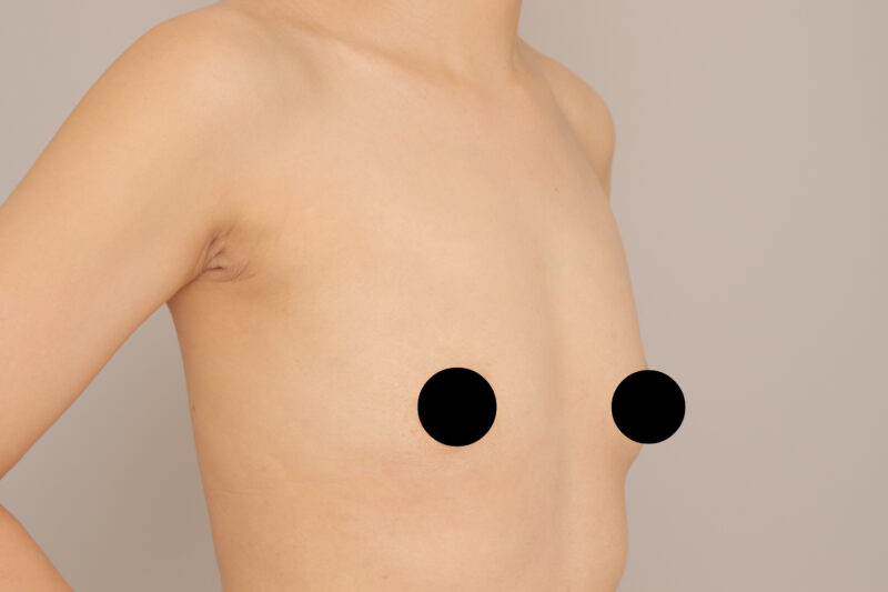 ベイザー脂肪吸引（１ヶ月経過：36）の術前写真