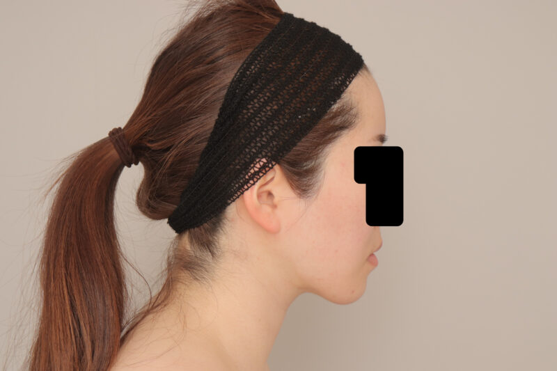 ベイザー脂肪吸引(1ヶ月経過:27)の術後写真