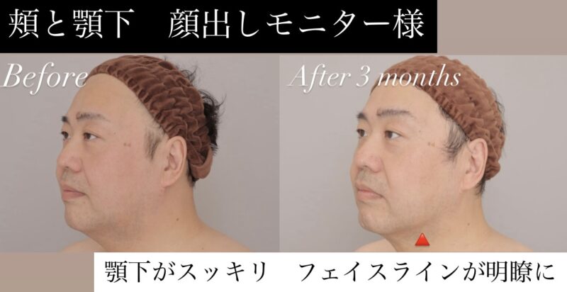 【顔出しモニター様】頬＋顎下の術後3か月時点の変化！