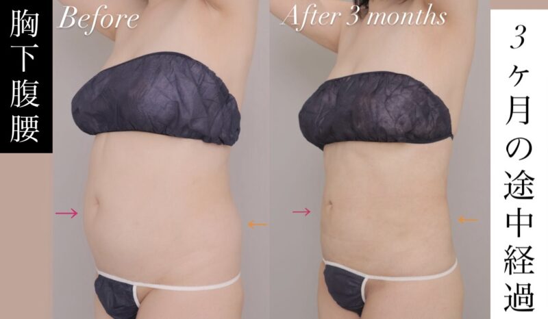 【腹部全体＋胸下＋腰部】術後3ヶ月時点の途中経過です