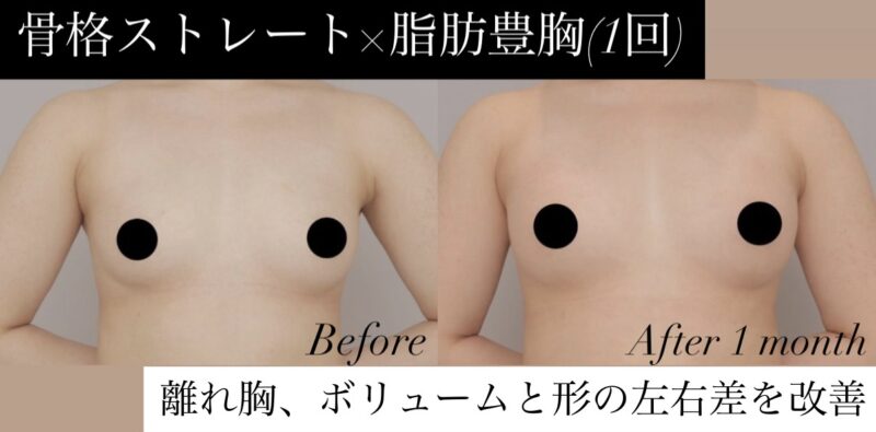 【骨格ストレート×脂肪豊胸1回】離れ胸と左右差、デコルテのそげを改善したい方