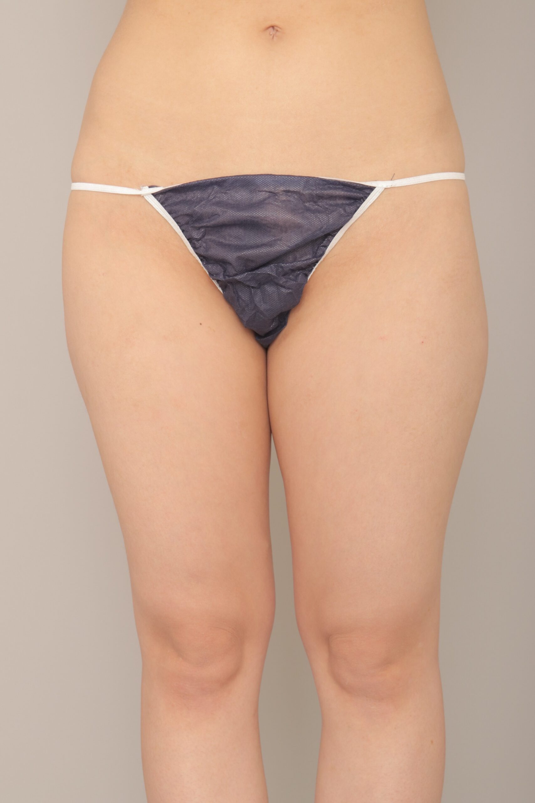 ベイザー脂肪吸引（3か月経過：22）の術前写真