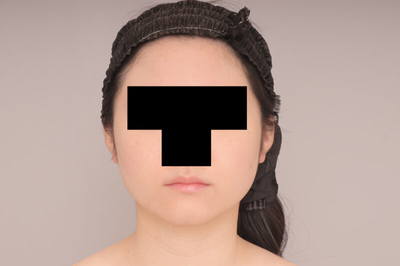ベイザー脂肪吸引（3か月後経過：26）の術前写真