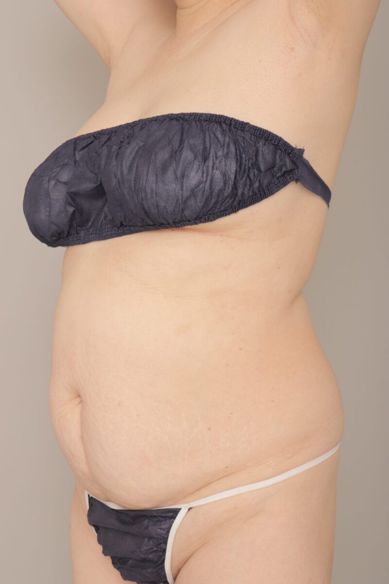 ベイザー脂肪吸引（６か月経過：57）の術前写真