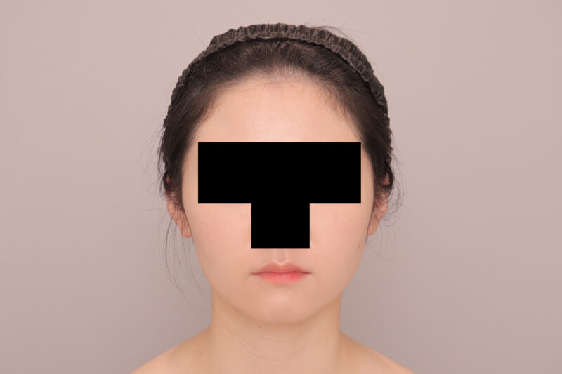 ベイザー脂肪吸引（3か月後経過：26）の術後写真