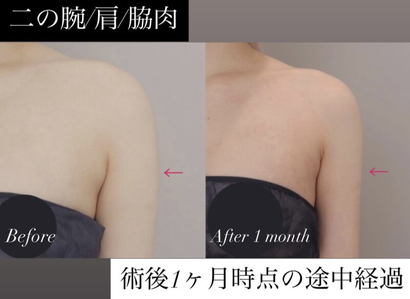 【1か月時点の途中経過】二の腕肩＋脇肉の脂肪吸引