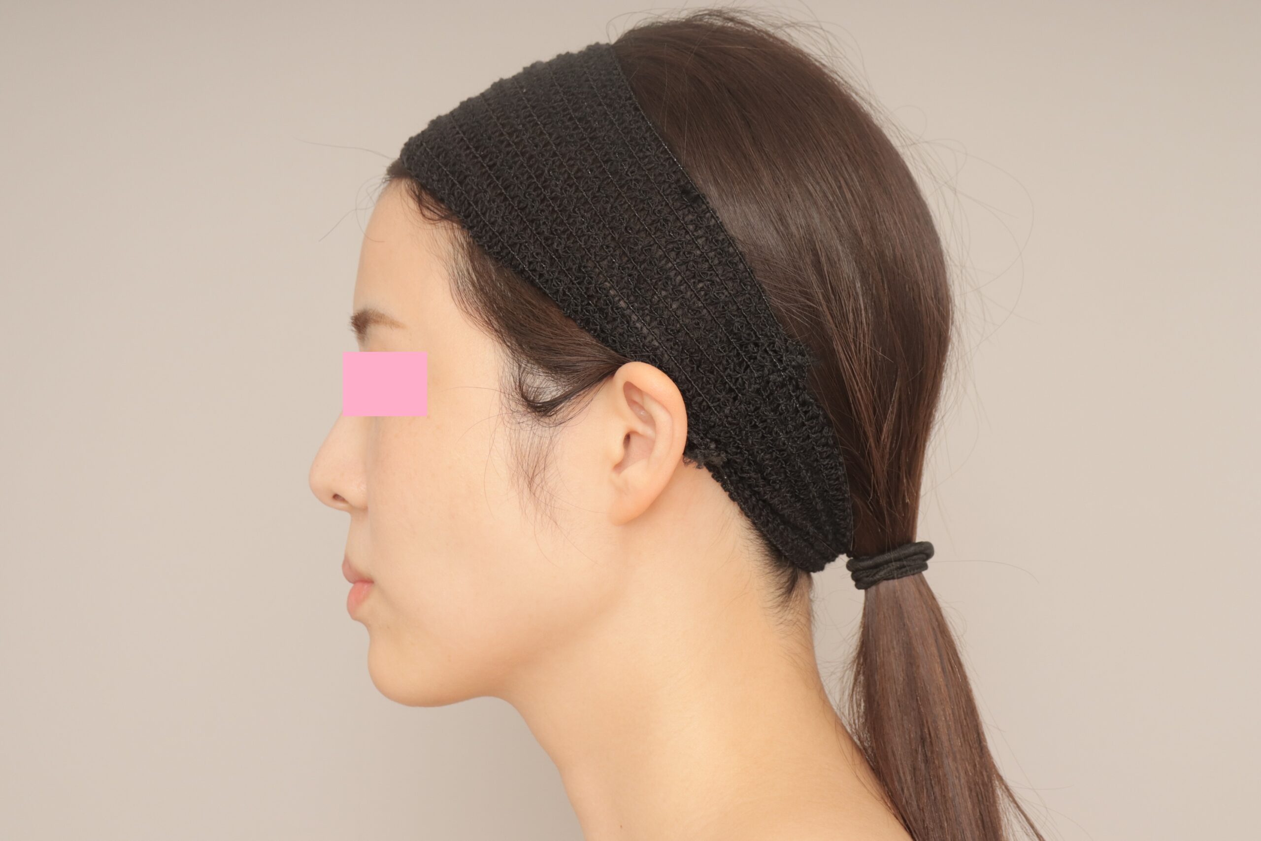 ベイザー脂肪吸引（1ヵ月経過：32）の術後写真