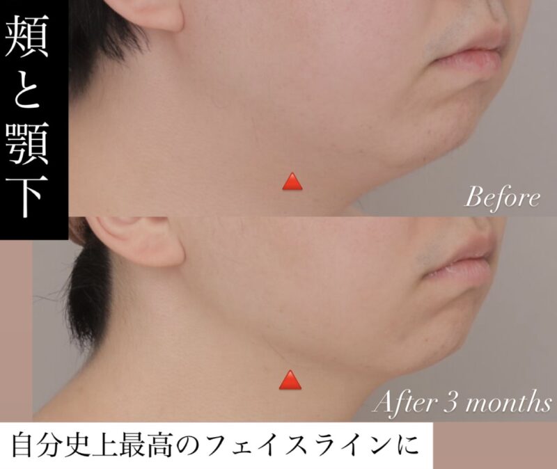 【頬＋顎下 3か月時点の経過】 自分史上最高のシャープなフェイスライン！