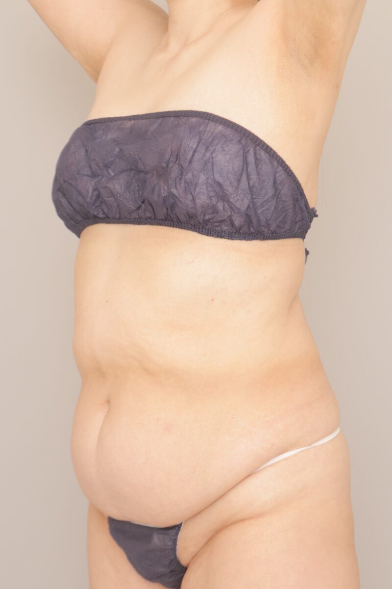 ベイザー脂肪吸引（半年経過：53）の術前写真