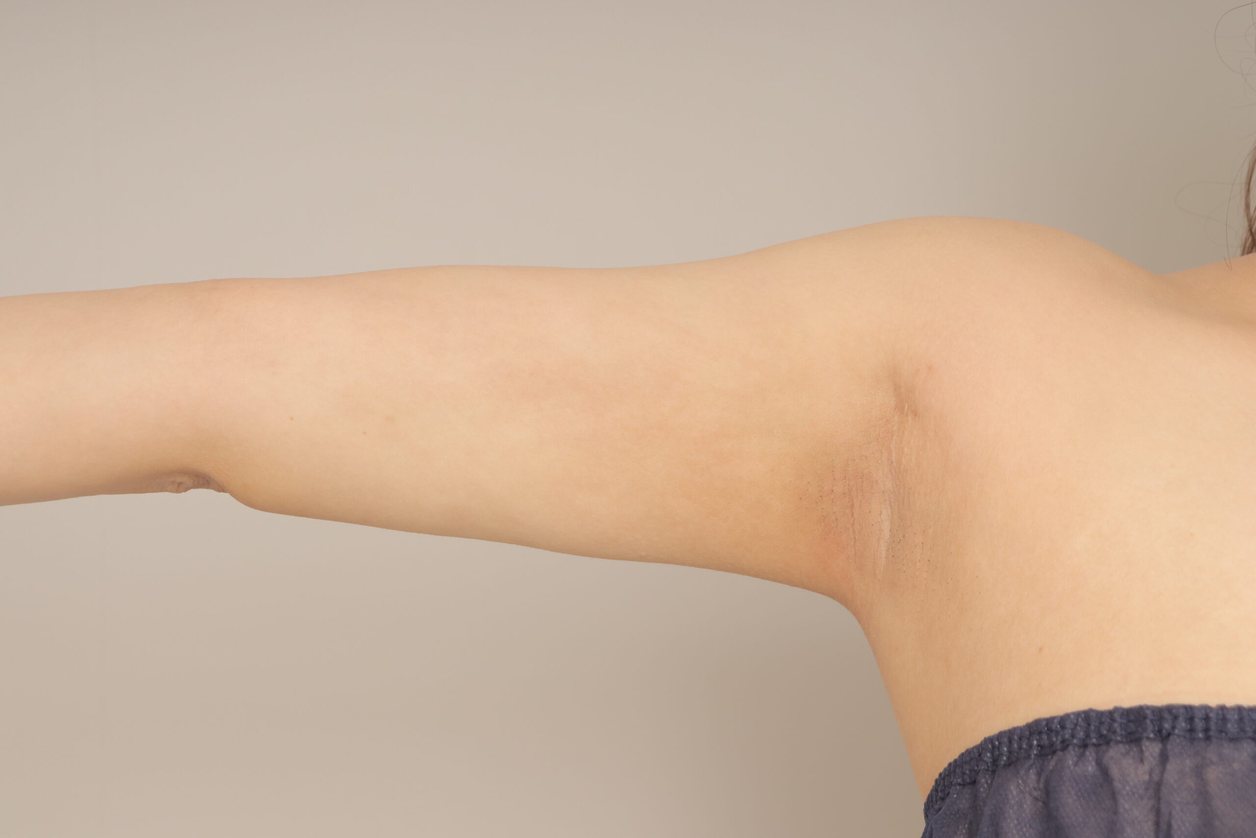 ベイザー脂肪吸引（1ヵ月経過：30）の術後写真