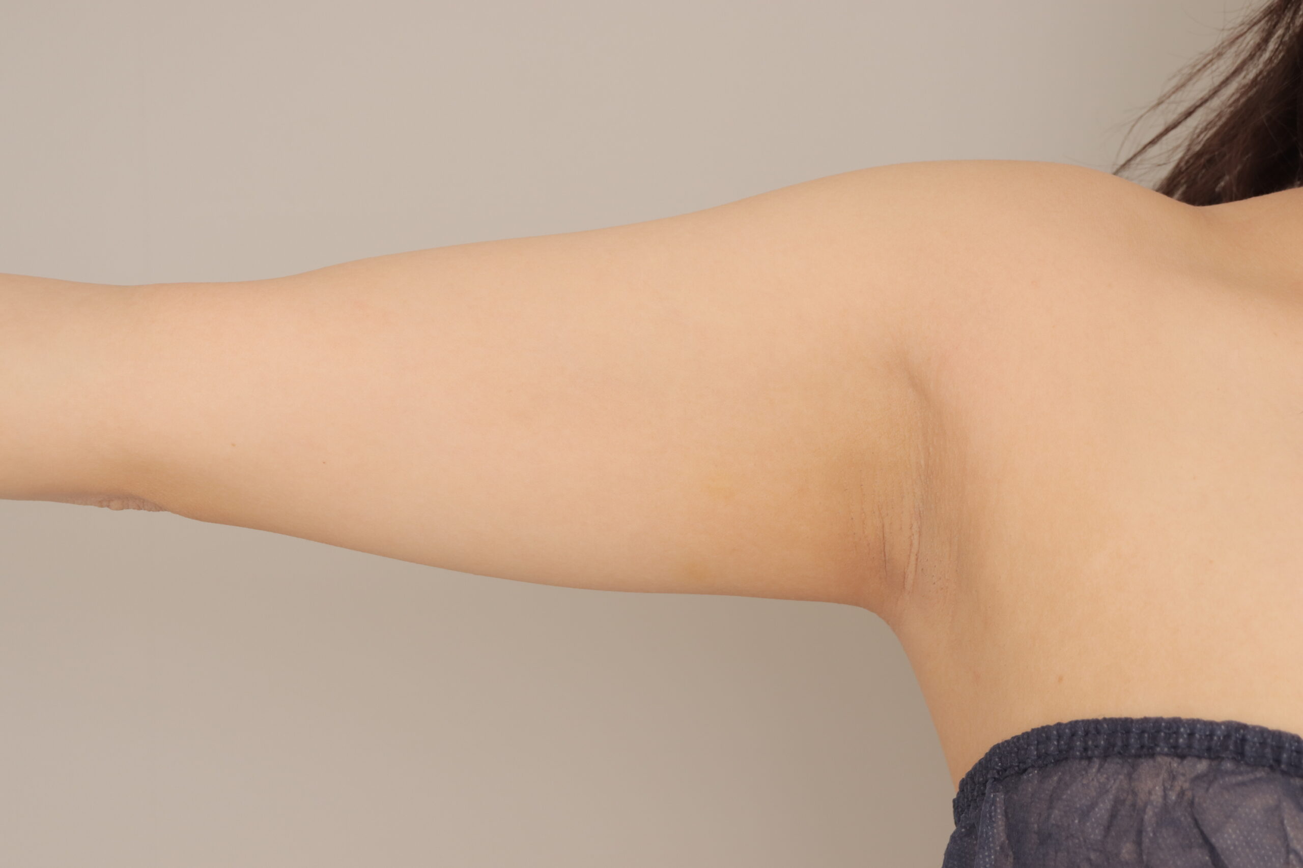 ベイザー脂肪吸引（1ヵ月経過：30）の術前写真