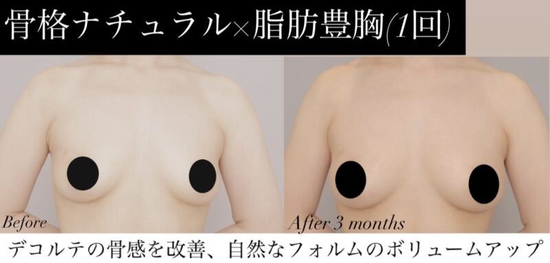 【骨格ナチュラル×脂肪豊胸（1回）】デコルテからふっくら、自信が持てるナチュラルな変化