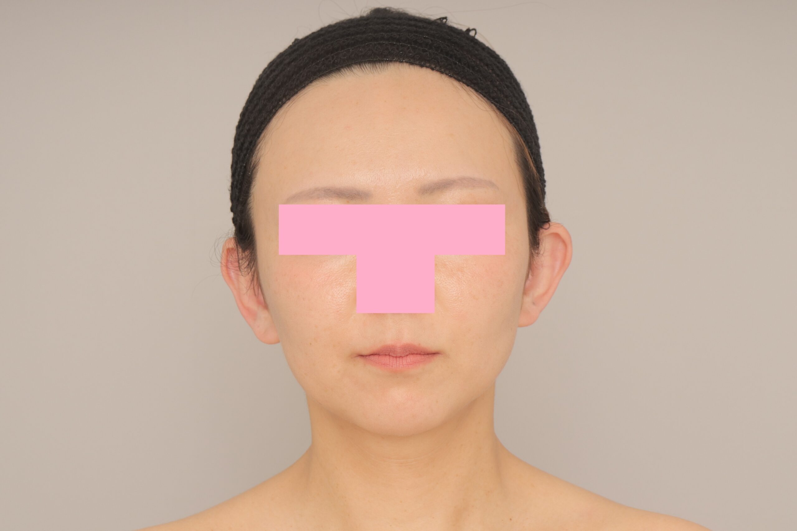 ベイザー脂肪吸引（3か月経過：43）の術後写真