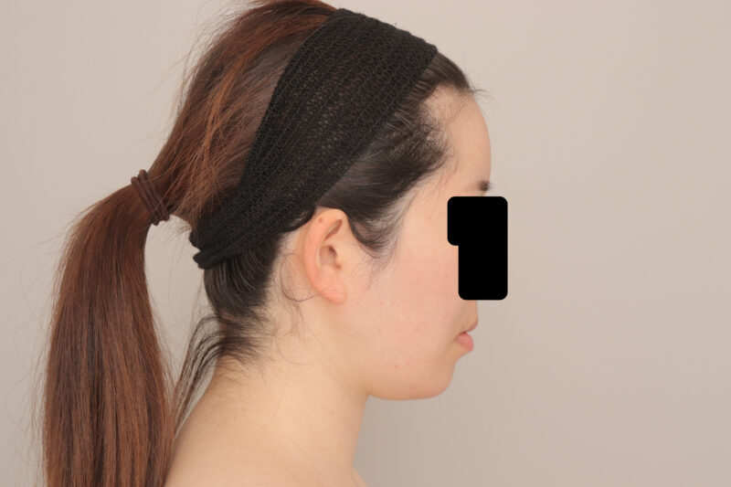 ベイザー脂肪吸引(1ヶ月経過:27)の術前写真