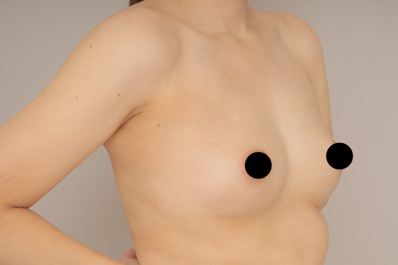 ベイザー脂肪吸引(1か月経過:34)の術後写真