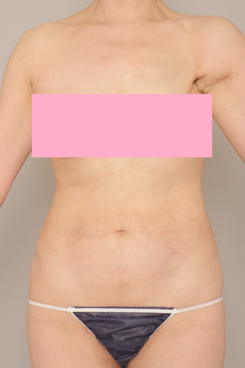 ベイザー脂肪吸引（6か月経過：49）の術後写真