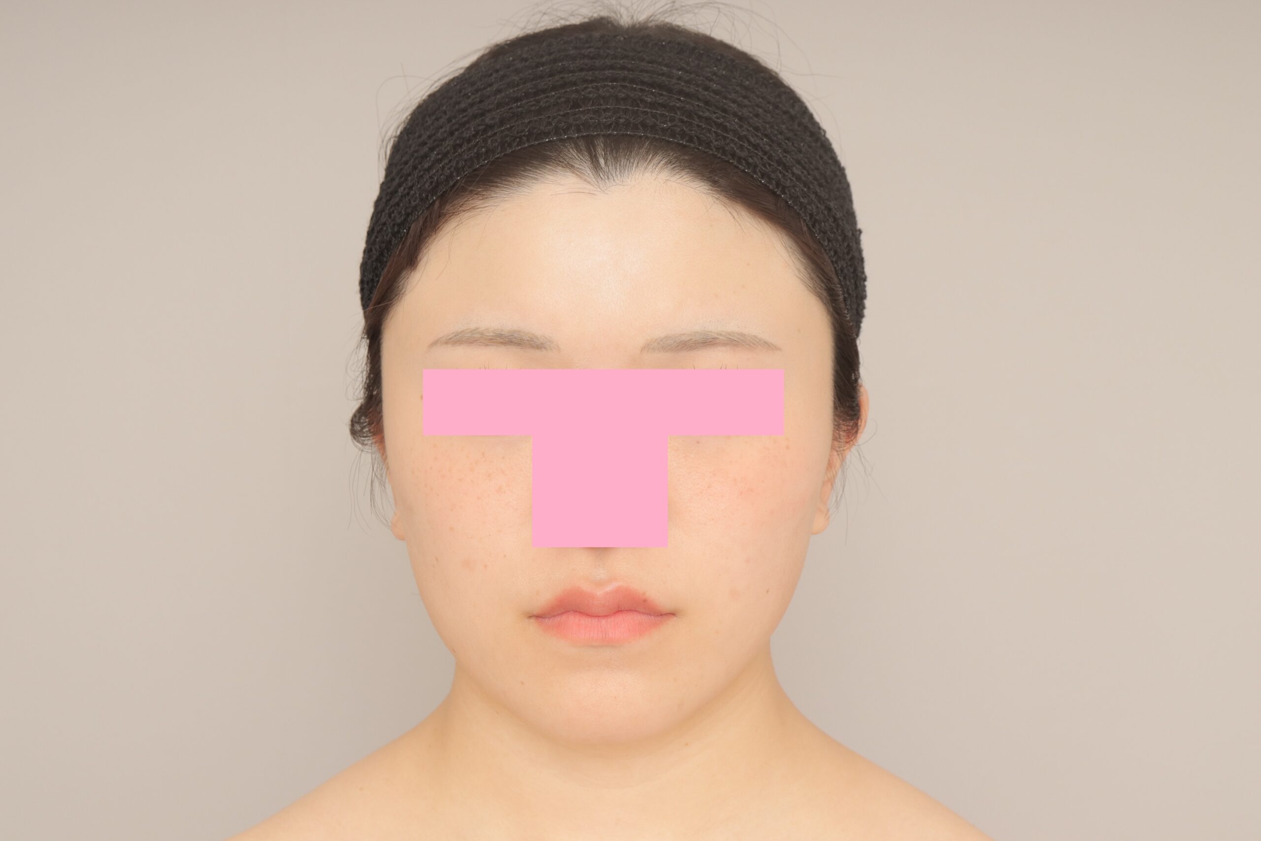 ベイザー脂肪吸引（3か月経過：22）の術後写真