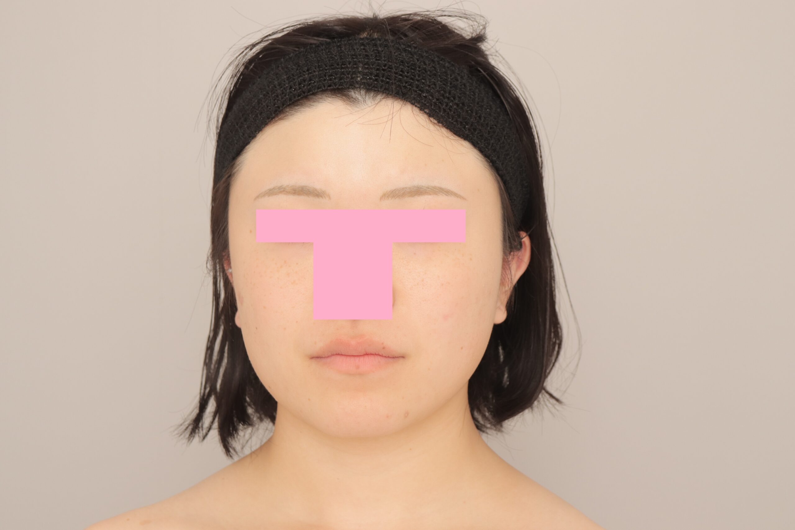 ベイザー脂肪吸引（3か月経過：22）の術前写真