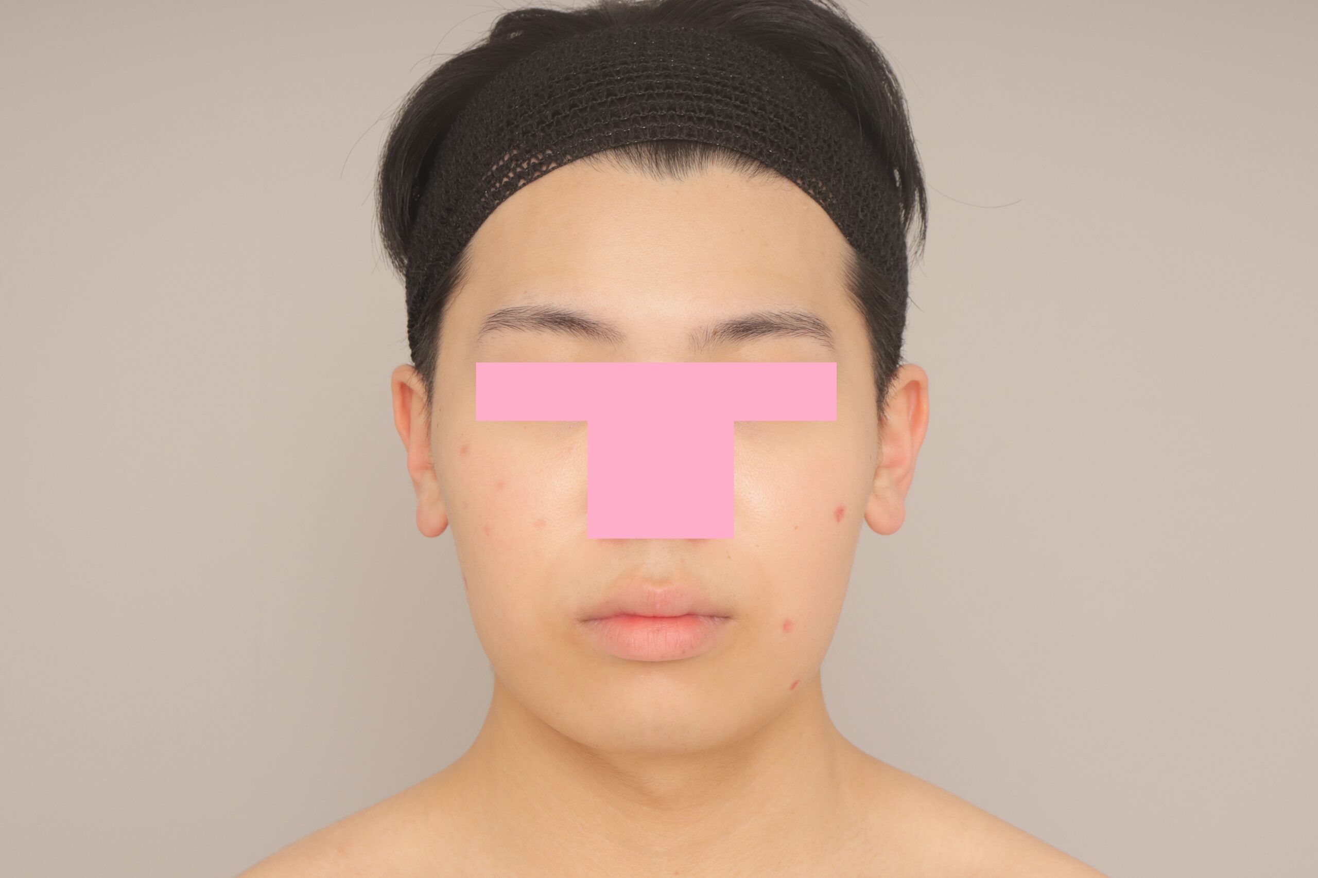 男性の吸引もたくさんしています！　頬顎下脂肪吸引モニター様の1か月経過をご紹介♪　21歳 161cm 59kg