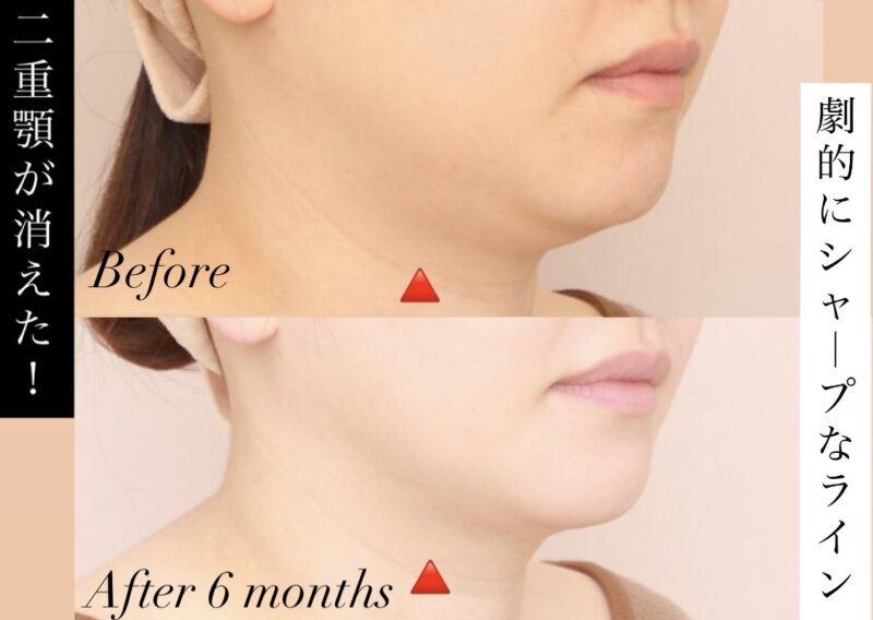 顎・顎下の「二重あご」が消えた！劇的にシャープな首元ライン