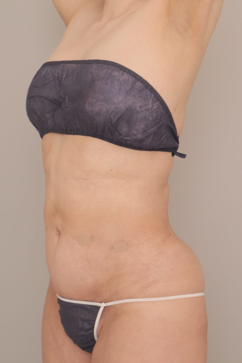 ベイザー脂肪吸引（半年経過：53）の術後写真