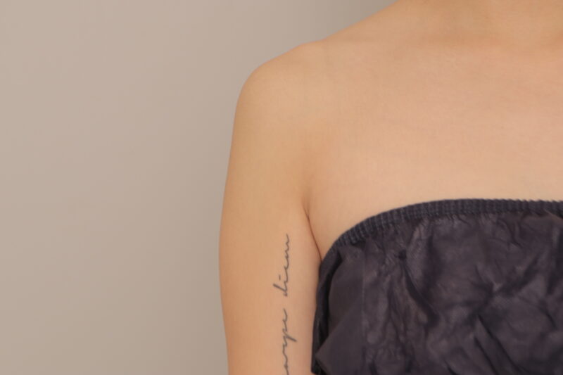 ベイザー脂肪吸引（3ヶ月経過：30）の術前写真