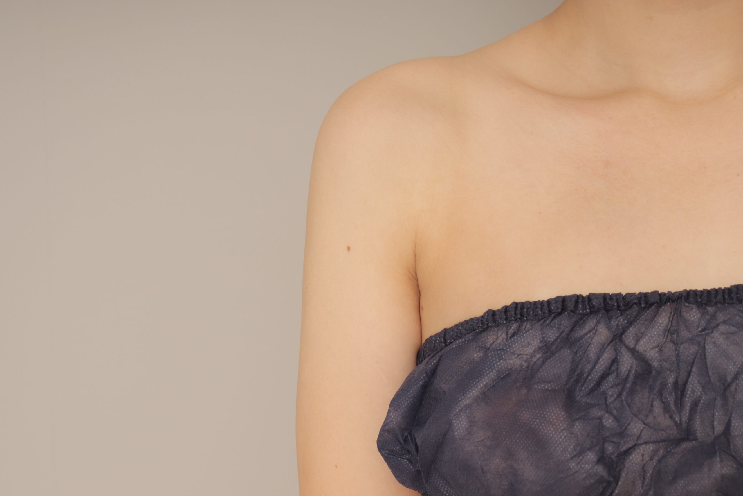 ベイザー脂肪吸引(1か月経過:34)の術後写真